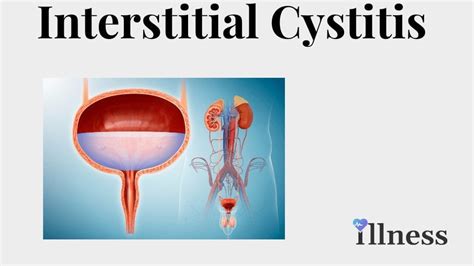 Interstitial Cystitis Ic Overview Causes Symptoms Treatment