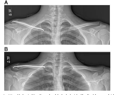 Figure 2 From Distal Clavicle Fracture Treated With A Titanium Elastic