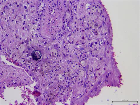 Pathology Outlines Xanthogranulomatous Pyelonephritis