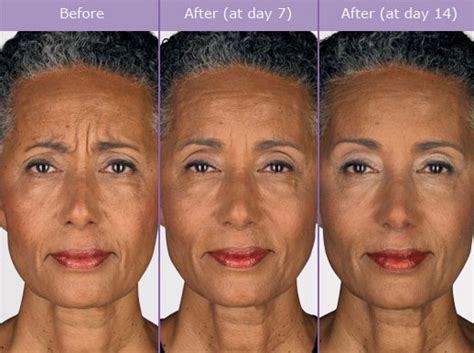 Botox Before After Photos Wrinkle Remover Dallas Plano Texas