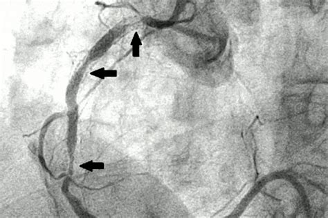 When Stents Dont Work For Blocked Arteries Targeted Radiation May Help