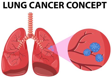 Diagram Of Lung Cancer Concept Vector Art At Vecteezy