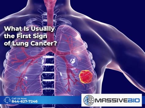 What Is Usually The First Sign Of Lung Cancer Massive Bio