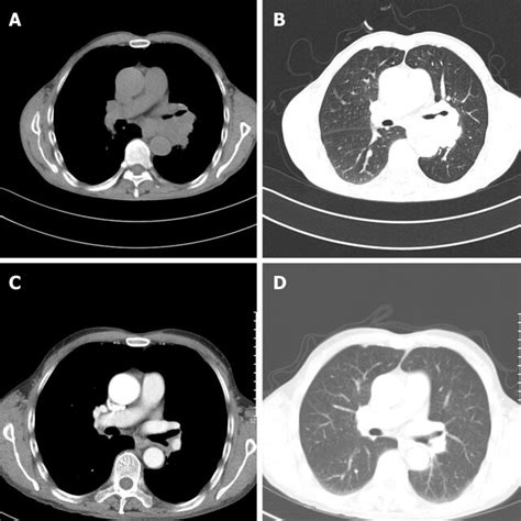 Computed Tomography Scan Of The Lung A B Chest Computed Tomography