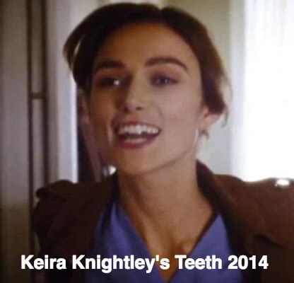I really love and appreciate keira knightley as a talented actress, and all around beauty for that matter, however her teeth are little below par, for celebrity standards. Keira Knightley Teeth Alignment - Did She Undergo teeth ...