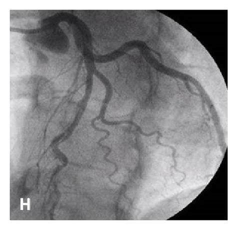 A Left Anterior Oblique Lao Projection Showing A Favourable