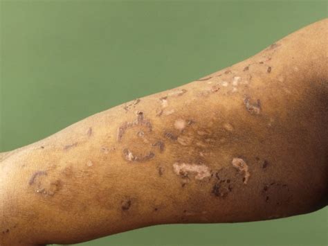 Dermatitis Herpetiformis Ziekte Van Duhring