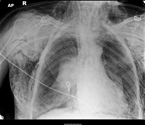 Massive Surgical Emphysema Secondary To Iatrogenic Tracheal Laceration