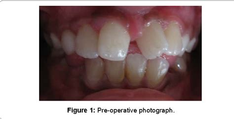 Figure 1 From Correction Of Midline Diastema And Rotated Central