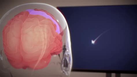 Neuralink Delon Musk Implante La Première Puce Cérébrale Chez Un