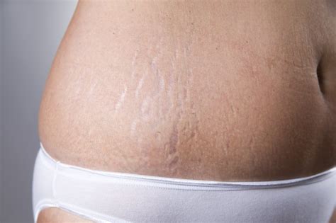 Can Toning Up Your Body Get Rid Of Stretch Marks Livestrongcom