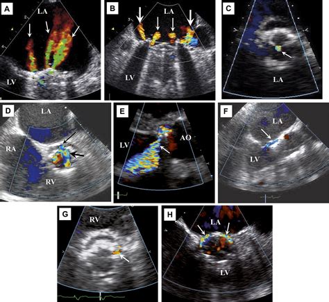 Doppler Echocardiographic Evaluation Of Prosthetic Valve Function Heart