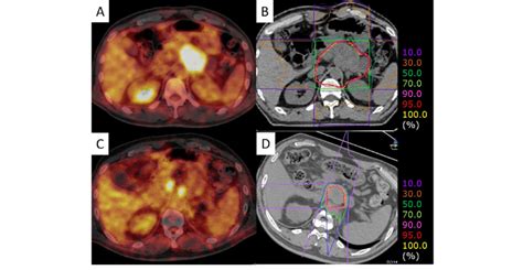 A Representative Patient With Pancreatic Body Cancer The Initial
