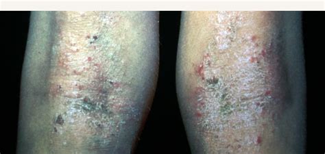 Eczema Dermatitis Sydney Dermatology Group