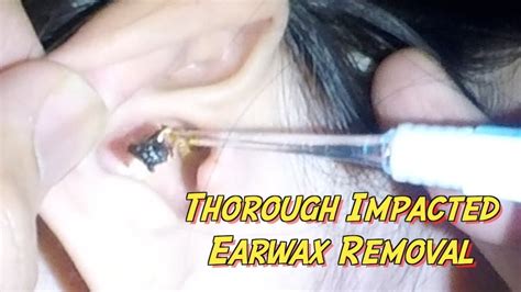 Girls Thorough Removal Of Impacted Earwax Youtube