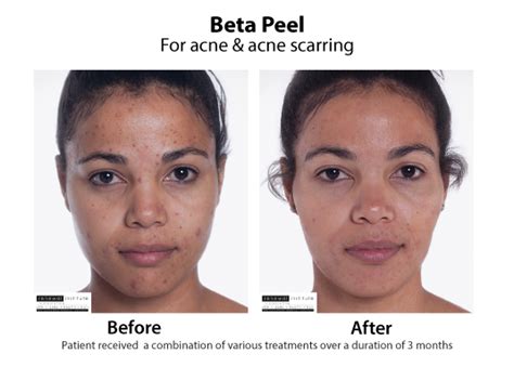 Beta Hydroxy Chemical Peel Beta Peel Skin Renewal