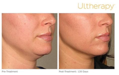 Ultherapy Before After Photos Mulberry House Clinic