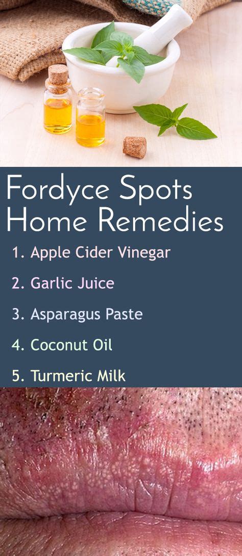 Home Remedies For Fordyce Spots On Lips Fordyce Turmeric Benefits