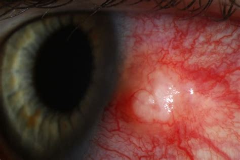 What Is Causing These Disturbing Changes In A Young Womans Eye
