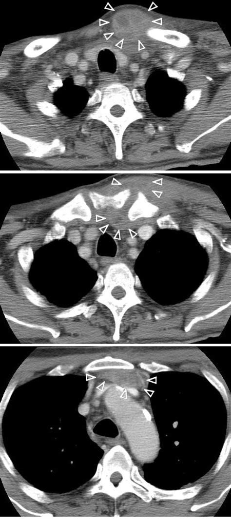 Thoracic Ct Scan A Ct Scan Using Intravenous Contrast Shows An Abscess