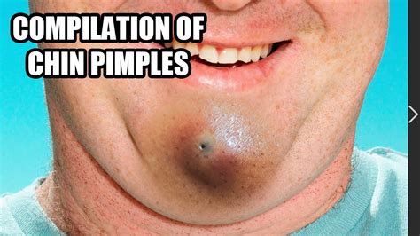 Chin Zits Chin Blackheads Chin Pimples And Pimple Pops Youtube