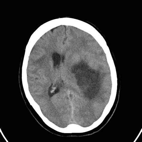 Anaplastic Astrocytoma Nos Image