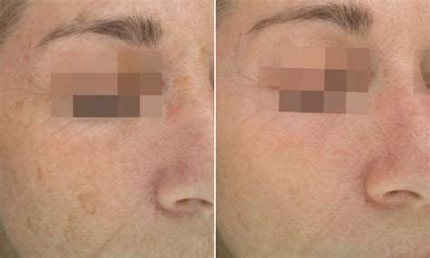 The Best Treatment For Face Pigmentation Removal Cosmelan The Brow