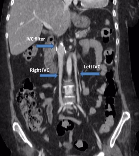 Duplicated Ivc With Suprarenal Ivc Filter