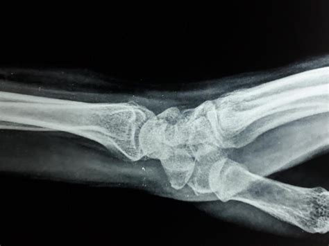 Scaphoid Fracture Hand Orthobullets