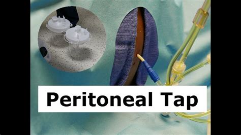 How To Do A Peritoneal Tap To Drain Ascites Fluid Youtube