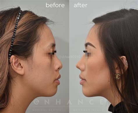 Asian Rhinoplasty Beverly Hills Ca Charles S Lee Md