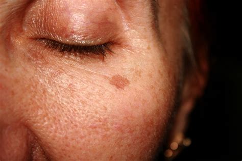 3 Easy Diy Dark Spot Remedies And One You Should Avoid