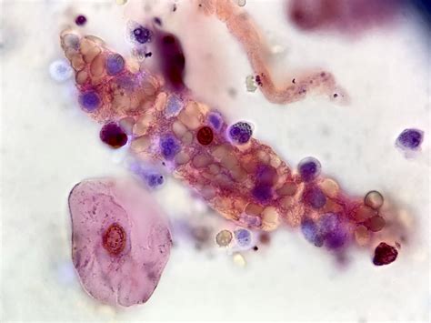 Urine Sediment Of The Month Mixed Cellular Casts Renal Fellow Network