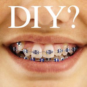 Did you scroll all this way to get facts about commercial braces? DIY Braces Can Ruin Your Child's Smile - Streamline For Kids