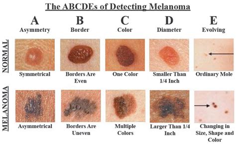 10 Skin Cancer Signs You Should Never Ignore Live Love Fruit