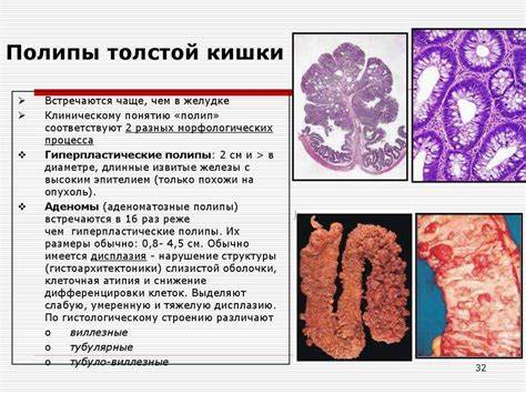 Полип толстой кишки диета Гиперпластический полип толстой кишки: что это такое Гиперпластический полип толстой кишки: что это такое Полип толстой кишки диета