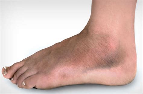 Broken Blood Vessel In Foot Pictures Symptoms And Pictures