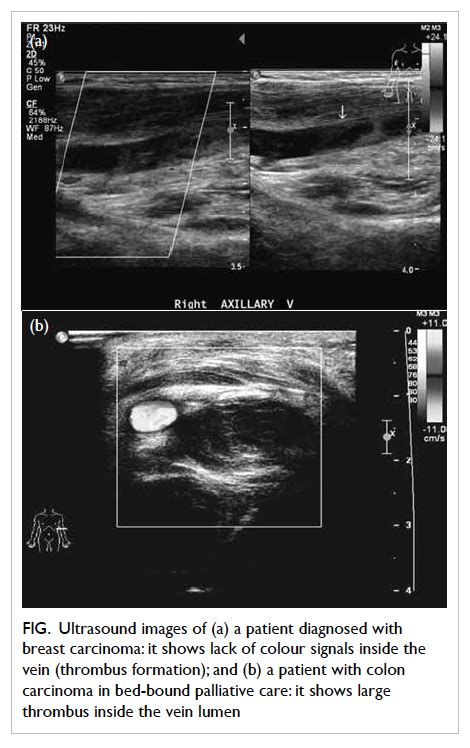 Upper Extremity Venous Ultrasound Template My Xxx Hot Girl