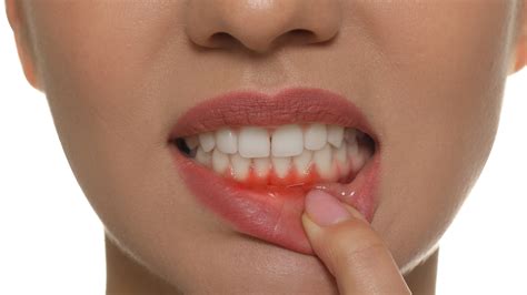 Your Guide To Early Signs Of Gum Disease Treatment