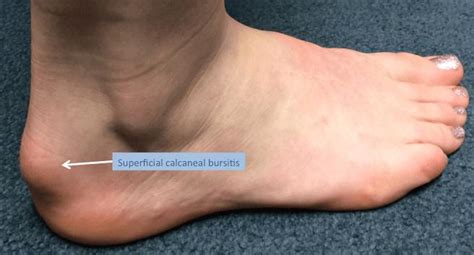 Ankle Bone Swelling