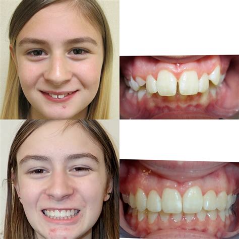 Before And After Braces Overbite