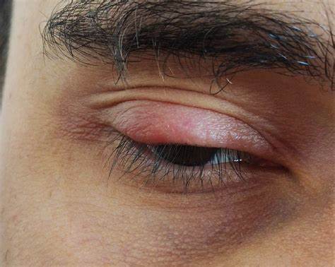 Острое воспаление холецистита диета Острое воспаление века - Вопрос офтальмологу - 03 Онлайн Острое воспаление века - Вопрос офтальмологу - 03 Онлайн Острое воспаление холецистита диета