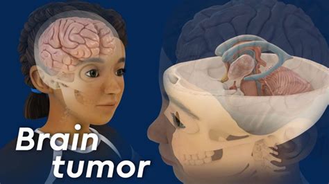 All You Need To Know About The Pediatric Brain Tumor
