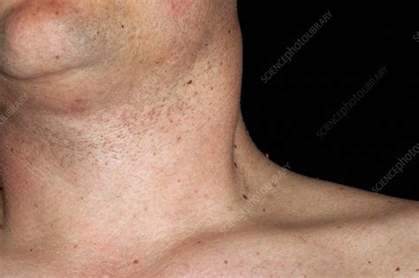 Neck Cancer Spread From The Tongue Stock Image C005