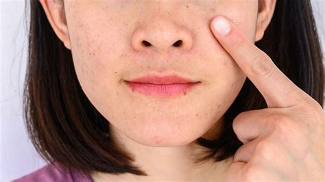 Post Inflammatory Hyperpigmentation Vs Melasma Whats The Difference