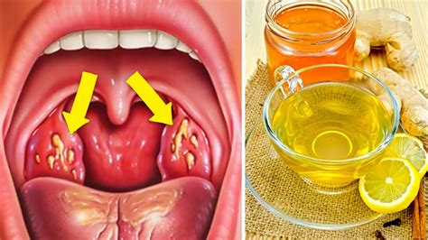 How To Cure Tonsillitis Fast And Naturally Youtube