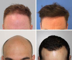 The Uks Best Hair Transplant Surgeons At The Private Clinic