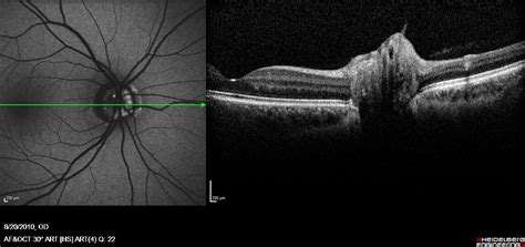 Imaging With Sd Oct • Image Of Optic Nerve Head Drusen Taken With A