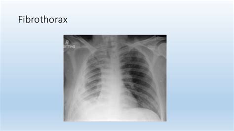 Pleural Tuberculosis Radhika