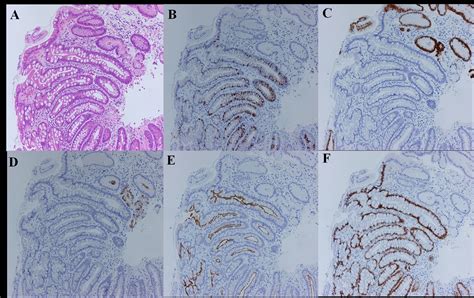 Predictability Of Gastric Intestinal Metaplasia By Mottled Patchy